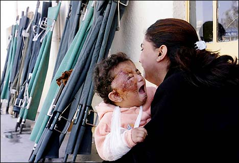 Iraqi child burned